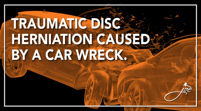 Traumatic Disc Herniation Caused by a Car Wreck.