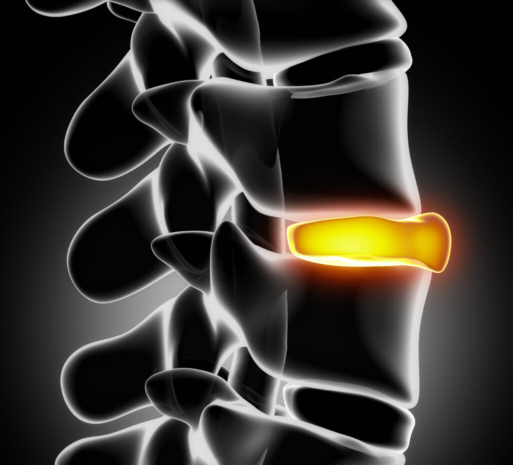 Traumatic Disc Herniation after Car Accident