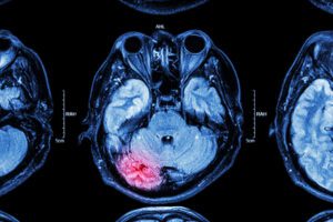 MRI showing traumatic brain injury (TBI)