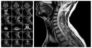x-rays showing neck or spine injury